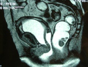 Imagen de Resonancia Magnética correspondiente a paciente con prolapso de órganos pélvicos. 